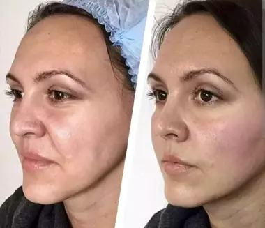 МЕЗОТЕРАПИЯ ДМАЭ. ЛИФТИНГ ЛИЦА.