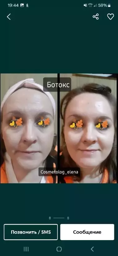 Нужны модели ботокс фулл фэйс все лицо+шея
