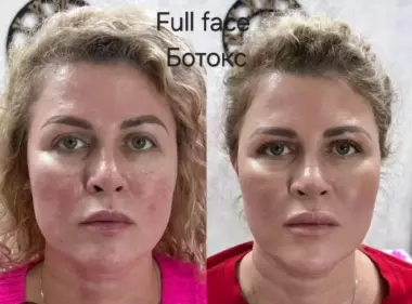 Нужны модели ботокс фулл фэйс все лицо+шея