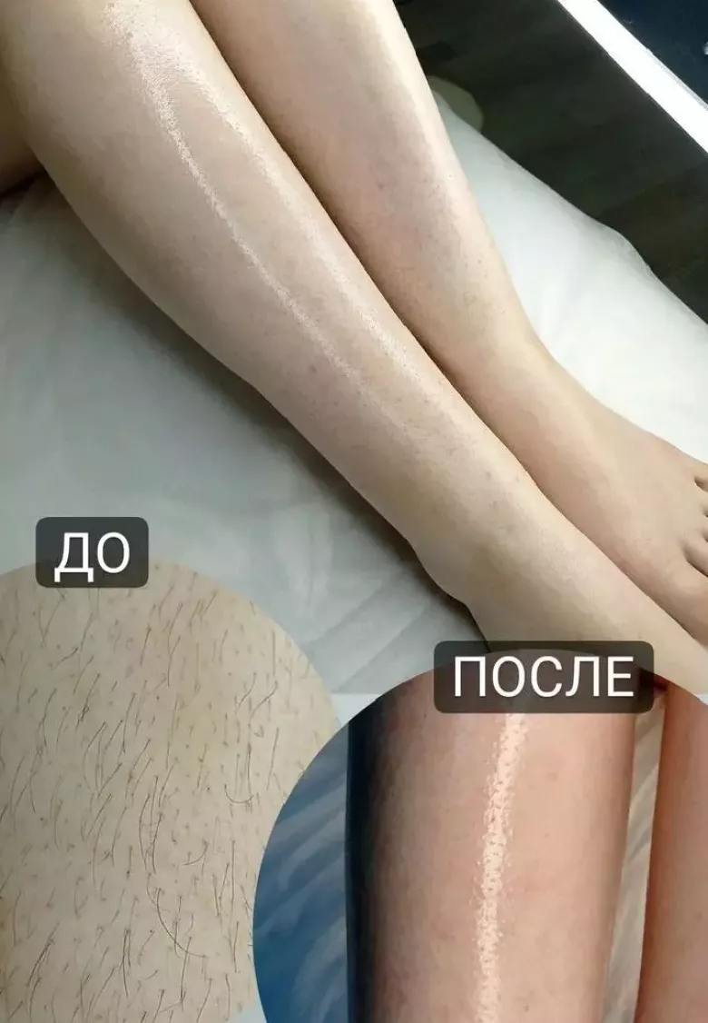 ЛАЗЕРНЫЙ ЭПИЛЯТОР — 3/3